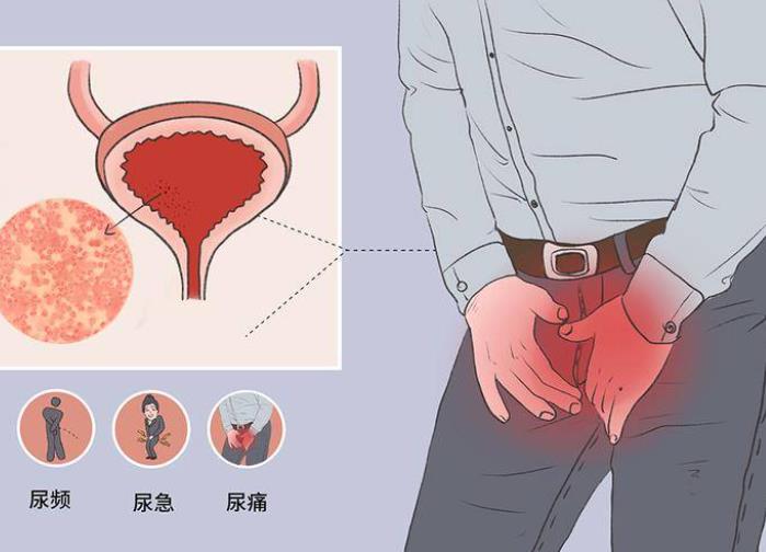 解读非淋菌性尿道炎：病因、症状与治疗方法