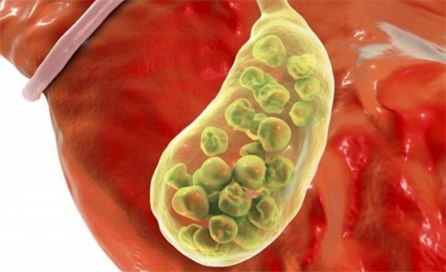 胆囊炎治疗：日常生活、药物还是手术？