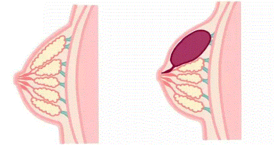 慢性乳腺炎：为何自行治愈不可行？